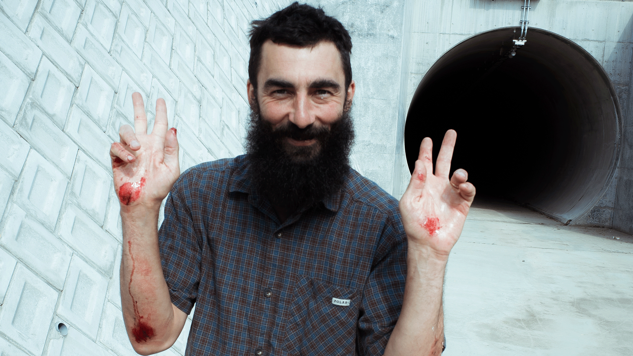 It was the gnarliest road rash I've ever gotten” – backstories